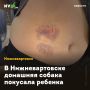В Нижневартовске домашняя собака покусала ребенка