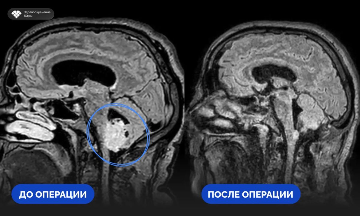 9 часов непрерывной работы - нейрохирурги Сургутской травмбольницы удалили редкую опухоль головного мозга в критически опасной зоне 9 часов непрерывной работы - нейрохирурги Сургутской травмбольницы удалили редкую опухоль головного мозга в критически опасной зоне