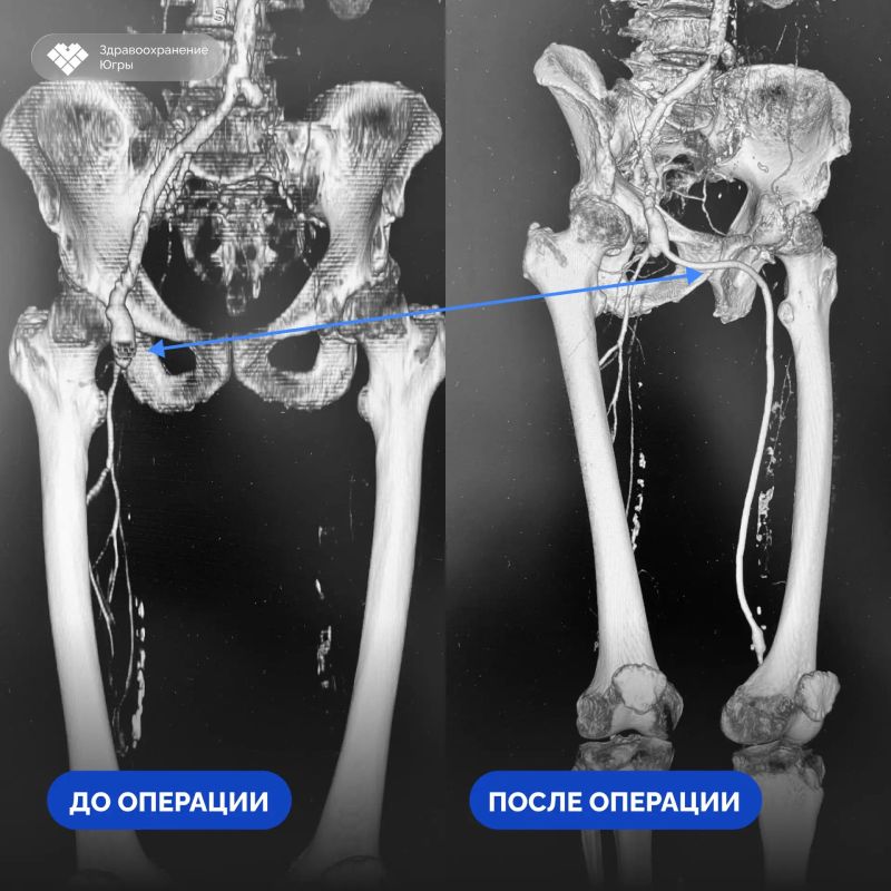 В обход рубцовой ткани: нижневартовские хирурги применили нестандартный доступ, чтобы сохранить ногу пациента В обход рубцовой ткани: нижневартовские хирурги применили нестандартный доступ, чтобы сохранить ногу пациента