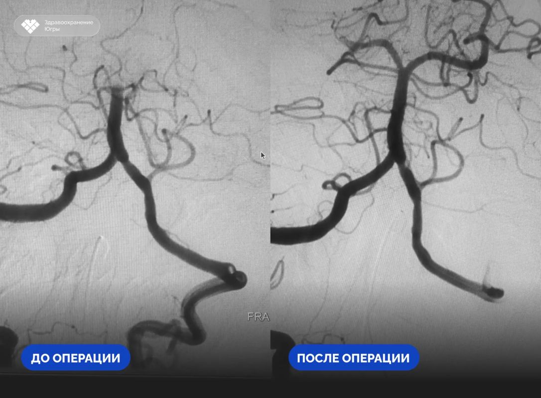 Инсульт ствола мозга: врачи Нягани спасли пациентку с тяжелейшим поражением Инсульт ствола мозга: врачи Нягани спасли пациентку с тяжелейшим поражением