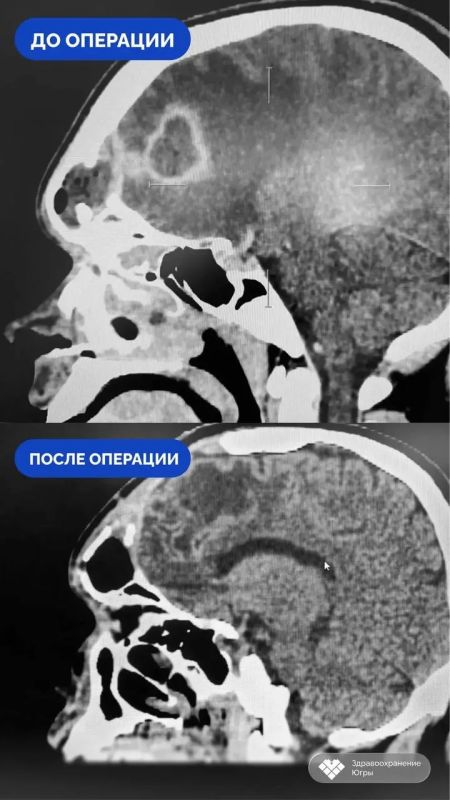 Врачи Сургута спасли пациента с абсцессом мозга, развившимся из-за запущенного насморка Врачи Сургута спасли пациента с абсцессом мозга, развившимся из-за запущенного насморка