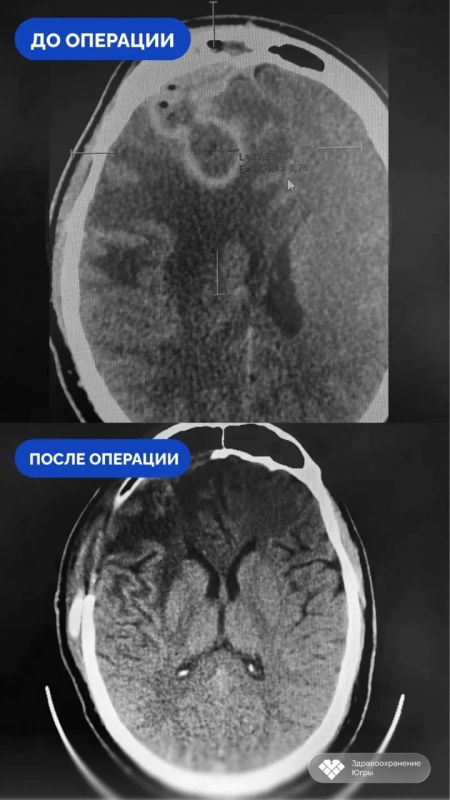 Самолечение насморка обернулось для сургутянина трепанацией черепа Самолечение насморка обернулось для сургутянина трепанацией черепа