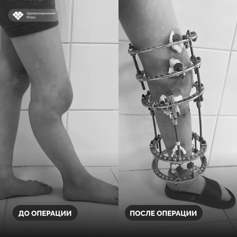 В Нижневартовской детской больнице устранили деформацию голени у шестилетнего пациента В Нижневартовской детской больнице устранили деформацию голени у шестилетнего пациента