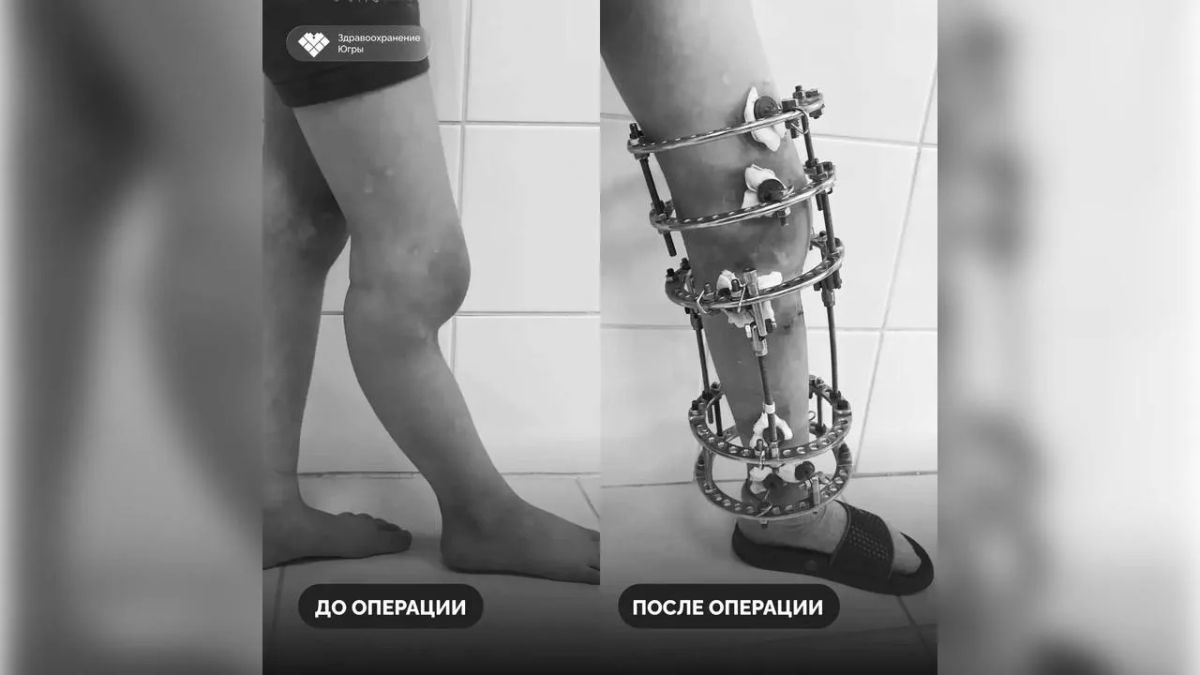 Нижневартовские хирурги исправили шестилетнему Данилу деформацию голени